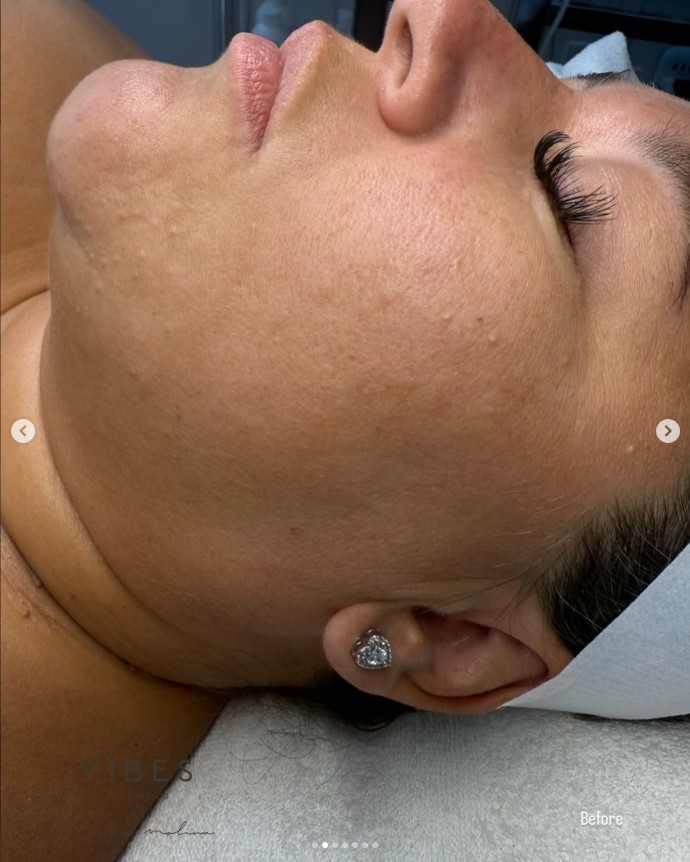 Before facial - skin texture and tone